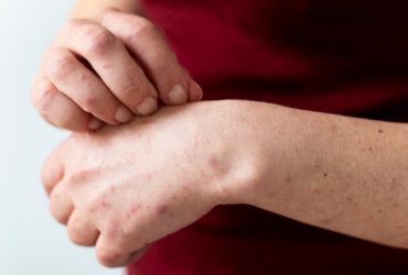 contraindicatii psoriazis